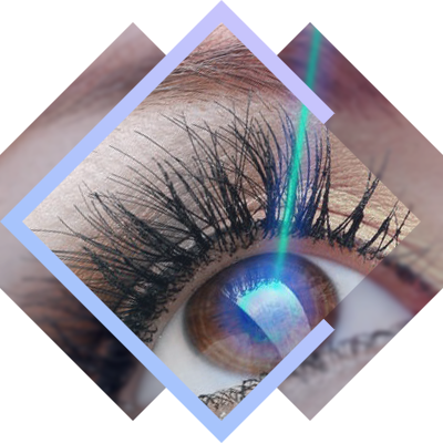 Cosmetic reasons laser eye