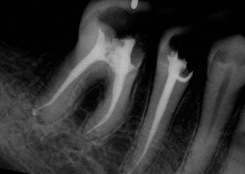 Teeth Roots